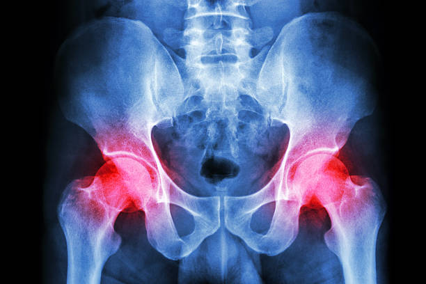 film x-ray menschliche's becken und arthritis in beiden hüfte - haunch stock-fotos und bilder