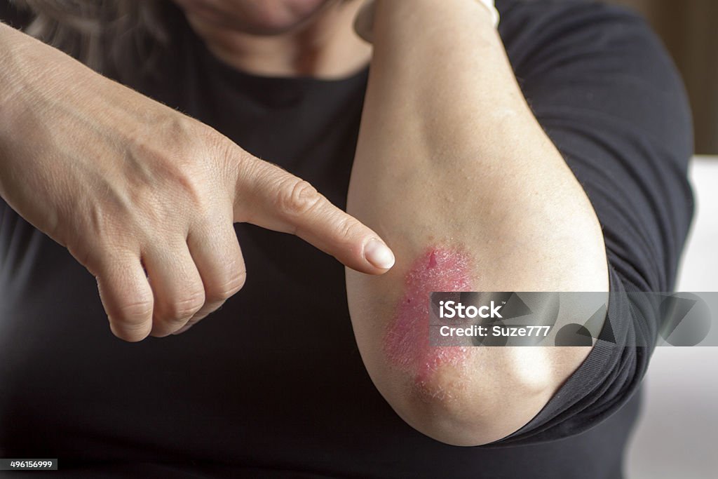 Psoriasis en codo - Foto de stock de Psoriasis libre de derechos