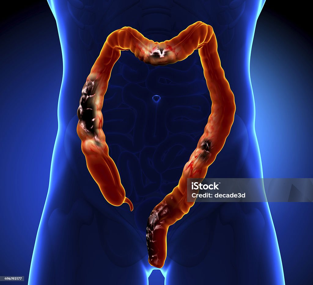 Colorectal cancer and Polyp Cancer - Illness Stock Photo