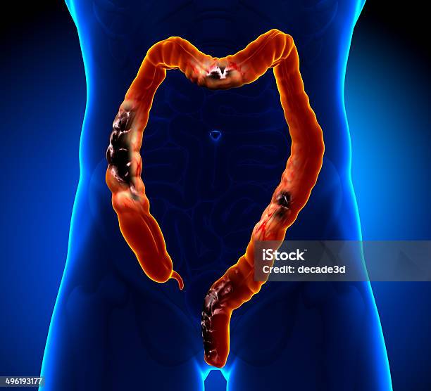 Colorectal Cancer And Polyp Stock Photo - Download Image Now - Cancer - Illness, Colon, Rectum