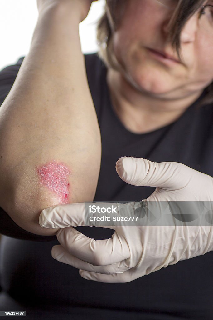 Psoriasis en codo - Foto de stock de Articulación humana libre de derechos