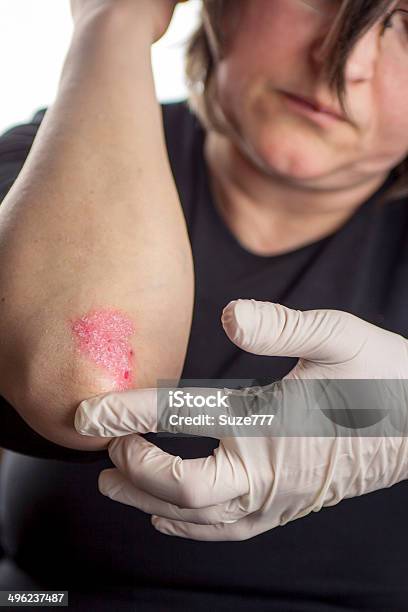 Psoriasis En Codo Foto de stock y más banco de imágenes de Articulación humana - Articulación humana, Asistencia sanitaria y medicina, Brazo humano