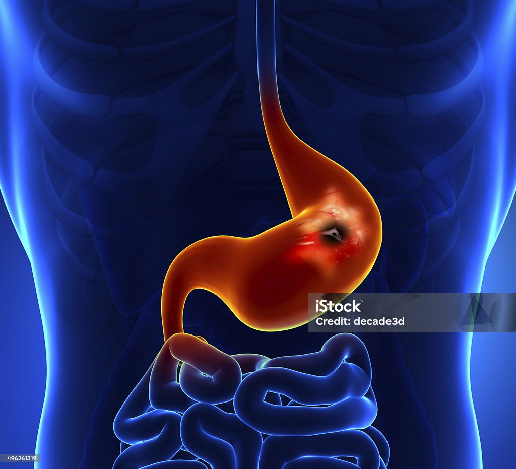 Peptic Ulcer Ulcer Stock Photo