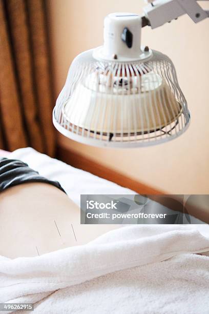 Acupuncture Stock Photo - Download Image Now - Alternative Therapy, Heat Lamp, Acupuncture