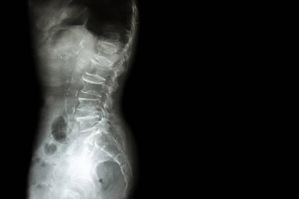 spondylosis, spondylolisthesis - x ray image x ray back low 뉴스 사진 이미지