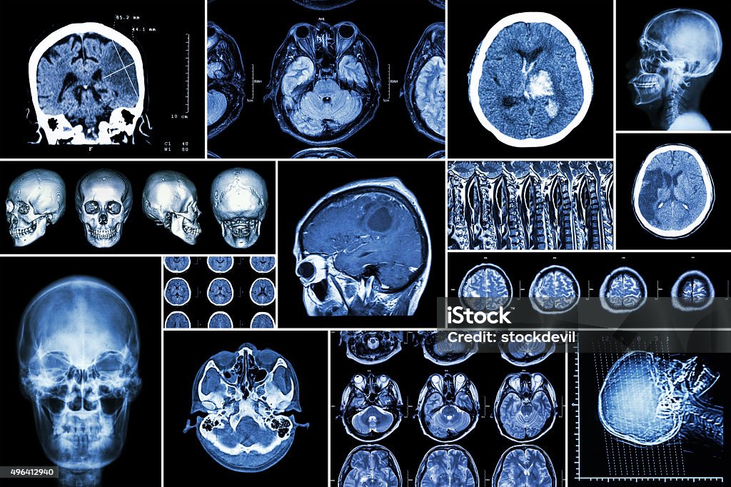 Set , Collection of brain disease Set , Collection of brain disease ( Cerebral infarction , Hemorrhagic stroke , Brain tumor , Disc herniation with spinal cord compression ,etc)( CT scan , MRI , MRT )( Neurology and Nervous system ) CAT Scan Stock Photo
