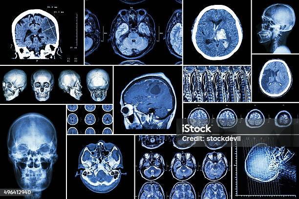 Set Collection Of Brain Disease Stock Photo - Download Image Now - CAT Scan, Blue, MRI Scan