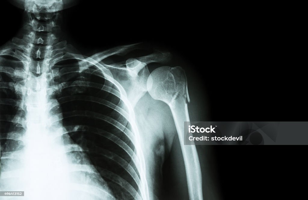 Fracture at neck of humerus ( arm bone ) Fracture at neck of humerus ( arm bone ) ( film x-ray left shoulder and blank area at right side ) 2015 Stock Photo