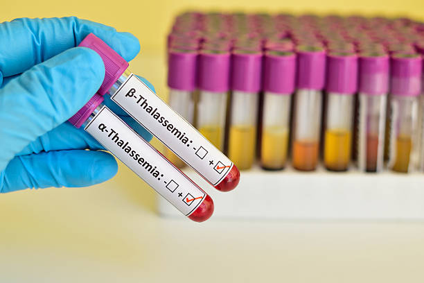 Beta and alpha thalassemia blood sample stock photo