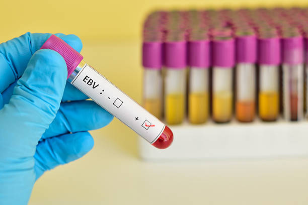 Epstein-Barr virus (EBV) Blood sample positive with Epstein-Barr virus (EBV) epstein barr virus photos stock pictures, royalty-free photos & images