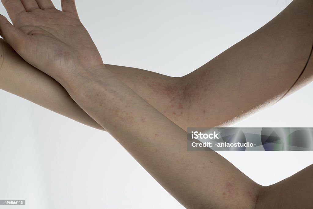 Allergie ill Haut auf der Seite - Lizenzfrei Atopisches Ekzem Stock-Foto