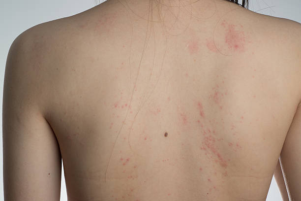 allergie ill haut am rücken - toxicodermatitis stock-fotos und bilder