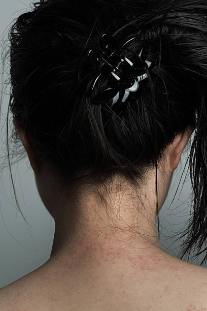 istock allergy ill skin on neck 496583621