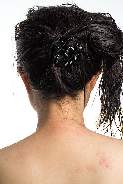 alergia źle skin na karku - eczema human neck toxicodermatitis close up zdjęcia i obrazy z banku zdjęć