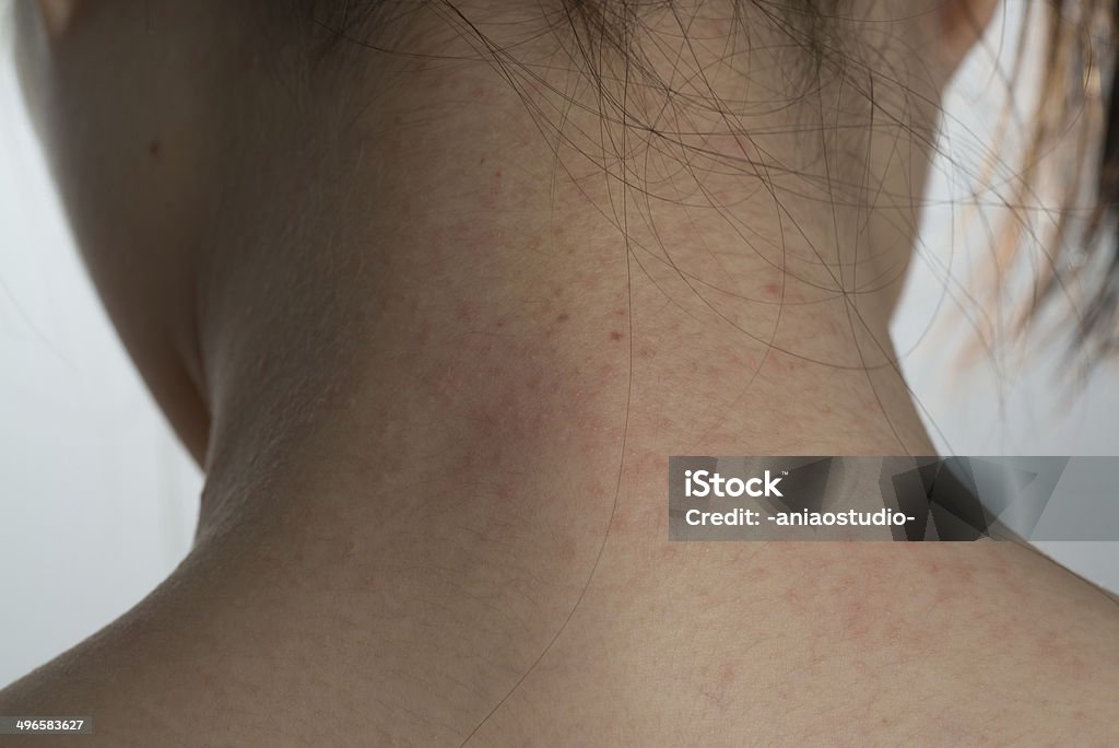 Allergie ill la peau au niveau de l'encolure - Photo de Adulte libre de droits