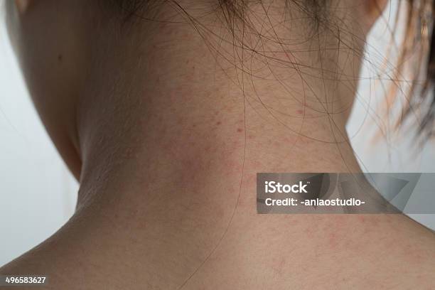 Photo libre de droit de Allergie Ill La Peau Au Niveau De Lencolure banque d'images et plus d'images libres de droit de Adulte - Adulte, Allergie, Blessure physique