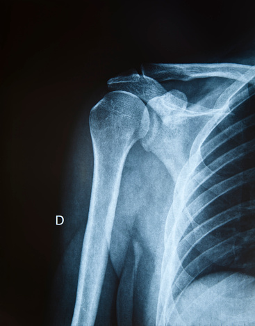 X-ray of shoulder, rib cage, collarbone and upper arm.