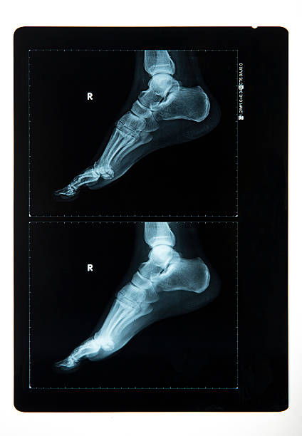istock X-Ray Image of a Man's foot 496585563