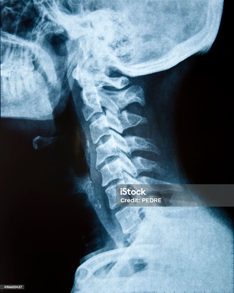 Cuello de rayos X - Foto de stock de Fractura libre de derechos