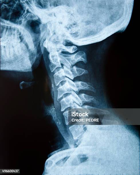 Cuello De Rayos X Foto de stock y más banco de imágenes de Fractura - Fractura, Vértebra humana, Ajuste quiropráctico