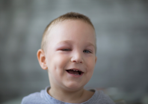 Little boy with swollen eye laughs