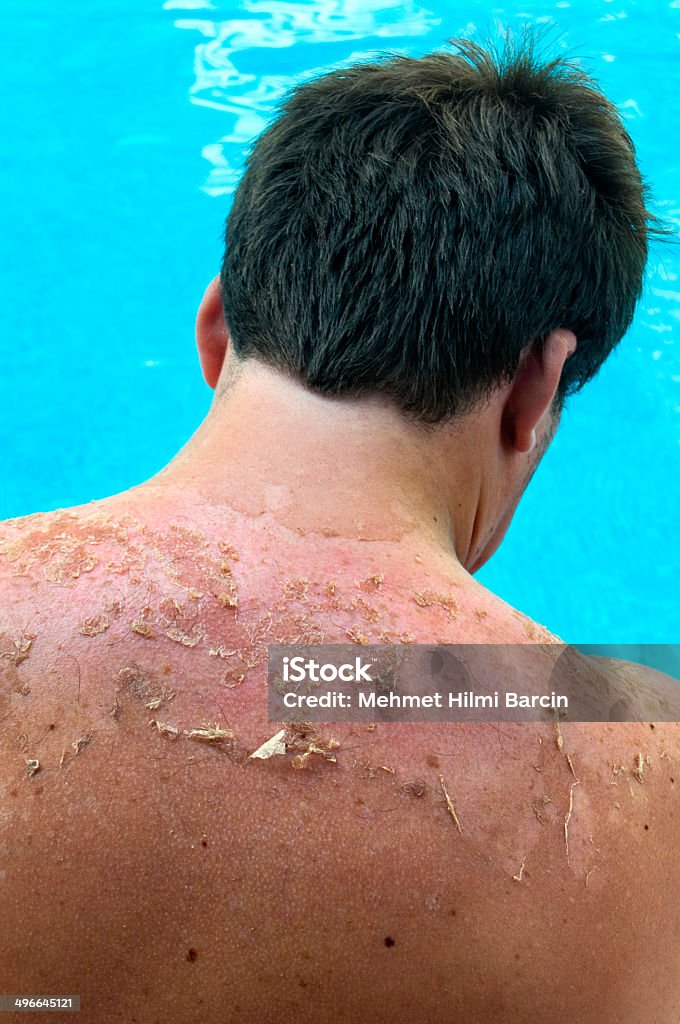 After a sunburn Peeling sunburned back Peeling Off Stock Photo