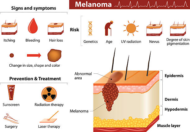 Skin cancer infographics Melanoma. Skin cancer infographics. Medical Infographic set with icons and other elements. melanoma stock illustrations