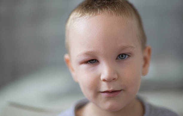 소년만, 부어오른 눈 - conjunctivitis sore eyes child human eye 뉴스 사진 이미지