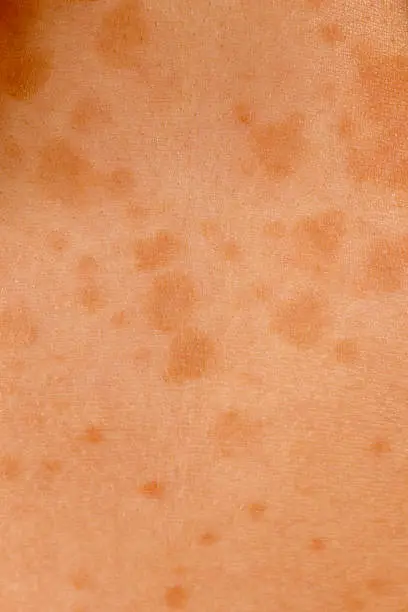 Photo of Medical: Tinea versicolor skin condition