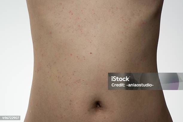 Alergia Doente Pele Na Barriga - Fotografias de stock e mais imagens de Abdómen Humano - Abdómen Humano, Adulto, Alergia