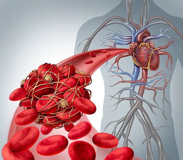 Photo of Blood Clot Risk