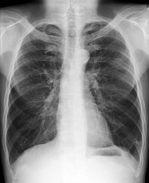 X-ray picture - Chest stock photo