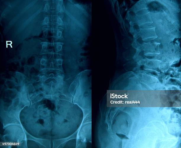 Позвонок Рентгенография — стоковые фотографии и другие картинки Рентгеновский снимок - Рентгеновский снимок, Вид сзади, Горизонтальный
