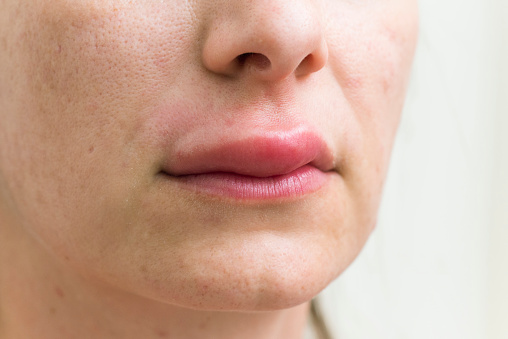 Close-up photo of the womans swollen lip from an alergic attack. Horizontal framing.