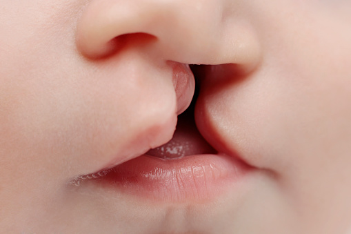 Close up on the lips of baby with lip and palate cleft before surgery. 