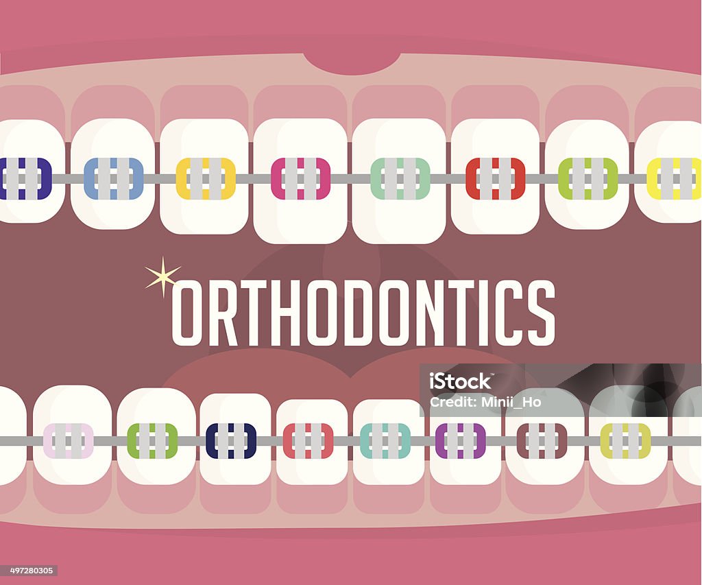 Ortodoncja, Aparat ortodontyczny - Grafika wektorowa royalty-free (Aparat ortodontyczny)