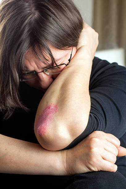 istock Unhappy woman with psoriasis 497286027