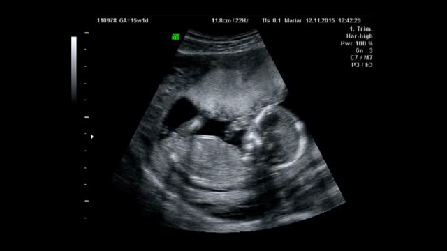 Baby Ultrasound
