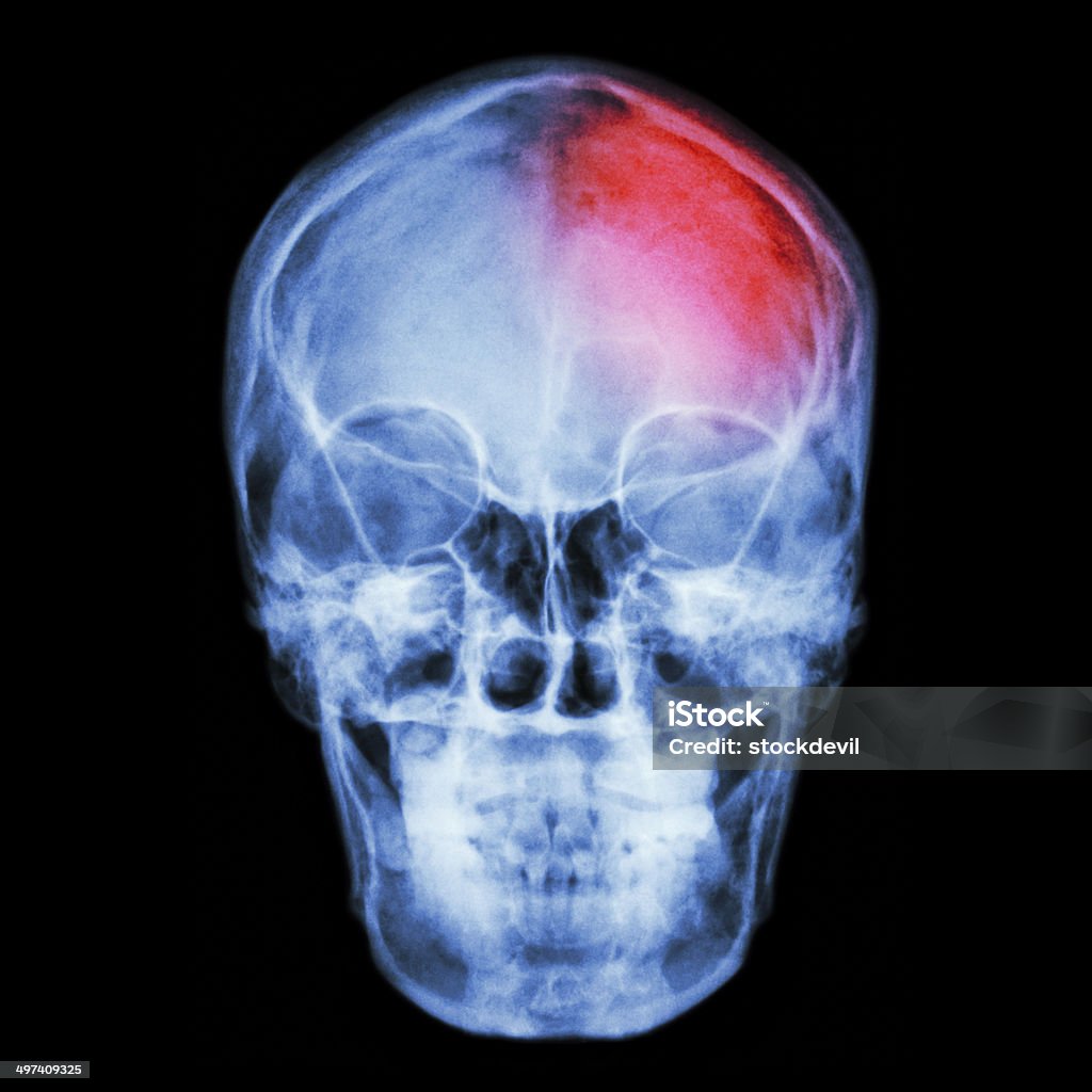 Película radiografías del cráneo y headache. (accidente Cerebrovascular, accidente Cerebrovascular). - Foto de stock de Cerebro libre de derechos