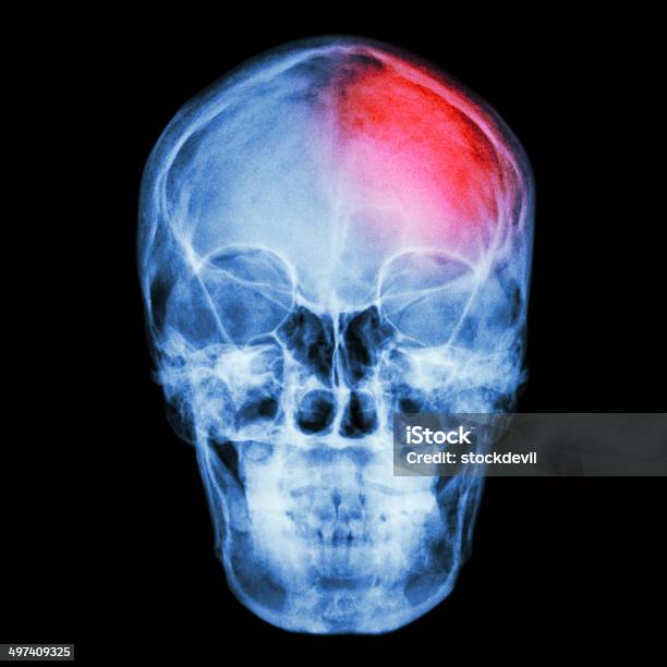 Película Radiografías Del Cráneo Y Headache Foto de stock y más banco de imágenes de Cerebro