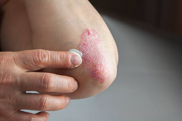 Psoriasis on elbow Psoriasis on elbow. Medical treatment photo psoriasis stock pictures, royalty-free photos & images