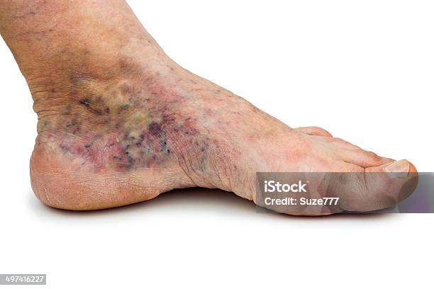 Varicose Vein Stock Photo - Download Image Now - Adult, Beauty Treatment, Blood Clot