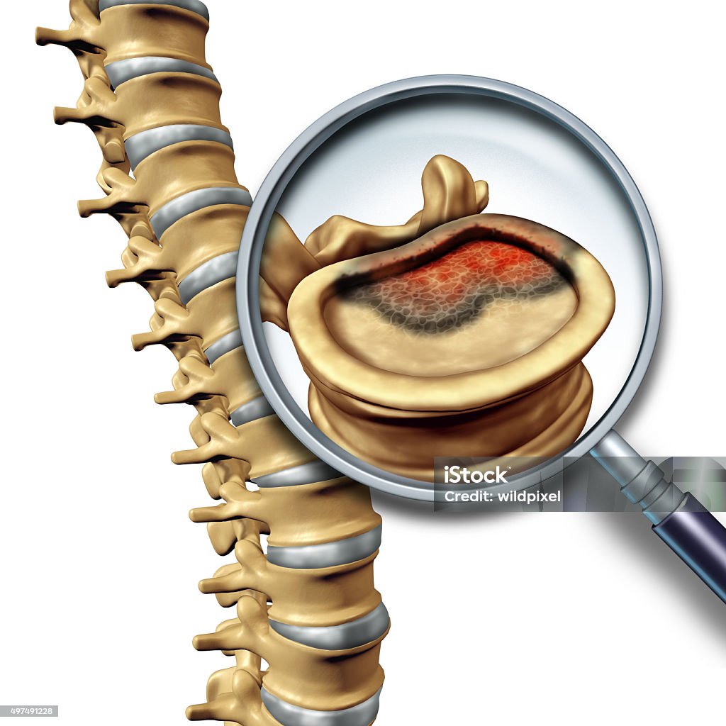 La columna Cáncer - Foto de stock de Cáncer - Tumor libre de derechos