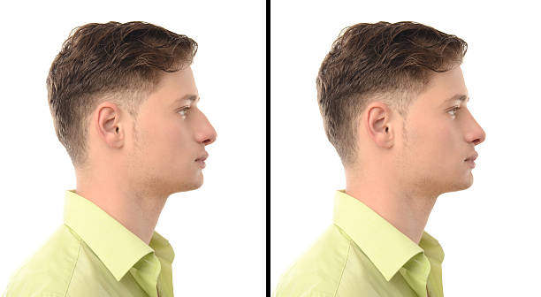 Before after photos of man with nose job plastic surgery. stock photo