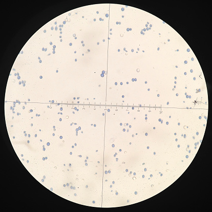Cytology smear of pleural effusion showing candida (fungi) organism mixed with white blood cells. Fungal hyphae are present in the smear along with leukocytes and protein.