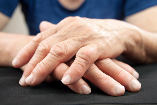 Mano de la mujer se deformen de la artritis reumatoide photo