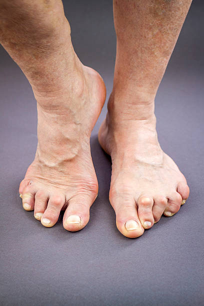 istock Feet Of Woman Deformed From Rheumatoid Arthritis 497589021