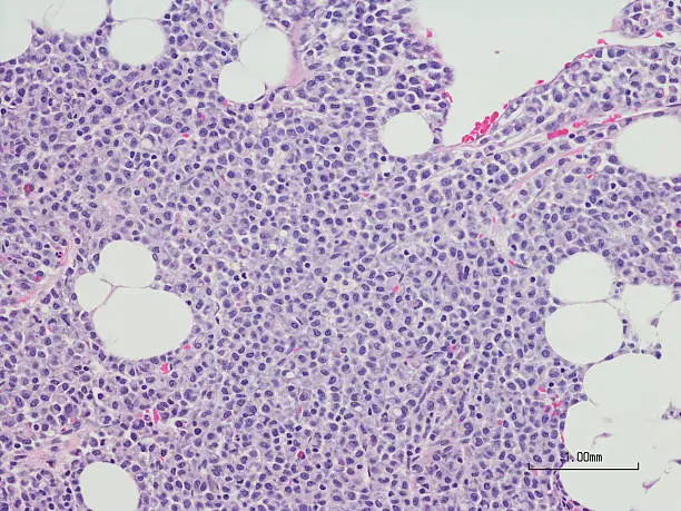 Microscopic photo of a professionally prepared slide demonstrating Plasma cell myeloma from bone marrow biopsy.  H&E Stain.