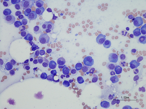 Microscopic photo of a professionally prepared slide demonstrating Plasma cell myeloma from bone marrow aspirate. Wright Giemsa stain.