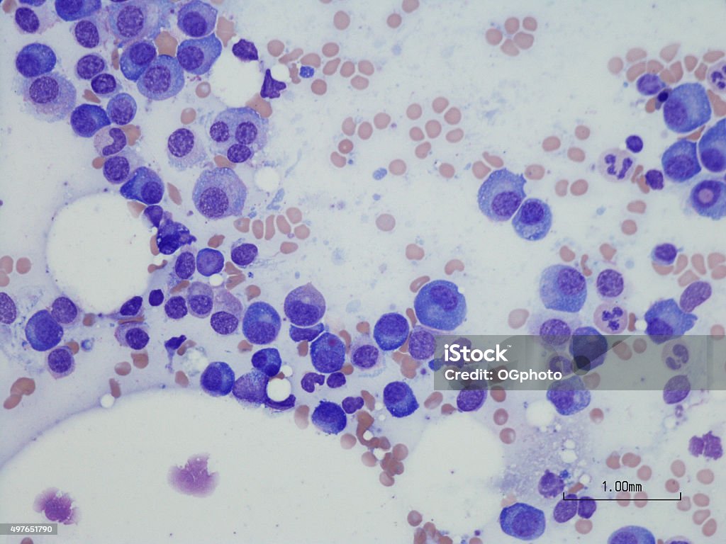 Plasma cell myeloma from bone marrow aspirate. Microscopic photo of a professionally prepared slide demonstrating Plasma cell myeloma from bone marrow aspirate. Wright Giemsa stain. Myeloma Stock Photo
